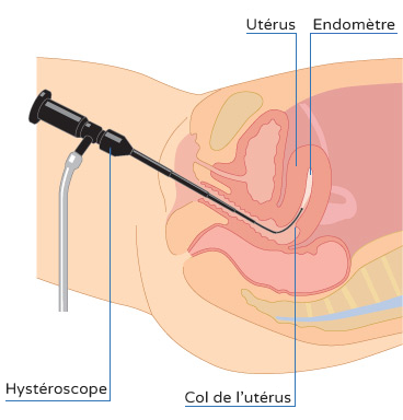 histeroscopia grafico fr